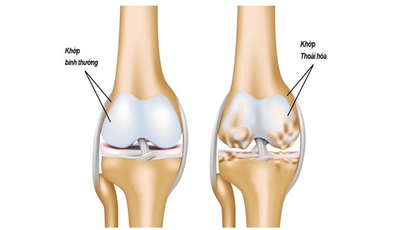 Những điều cần biết về cách chữa trị bệnh thoái hóa khớp ảnh 1
