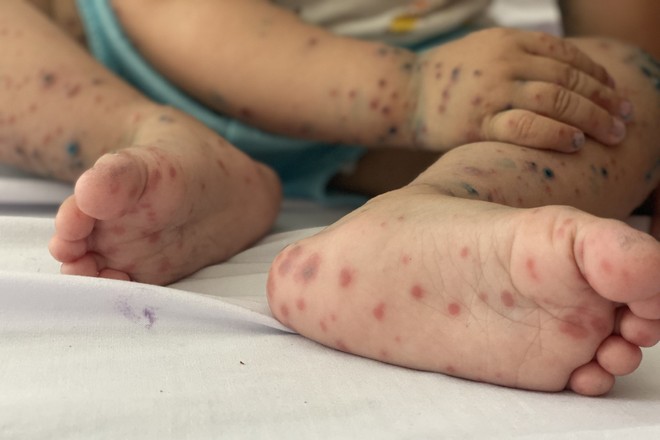 Dịch tay chân miệng ở Hà Nội vẫn đang trong giai đoạn cao điểm Dịch tay chân miệng ở Hà Nội vẫn đang trong giai đoạn cao điểm