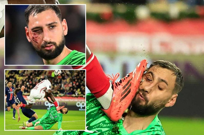 Khuôn mặt biến dạng của Donnarumma sau chấn thương