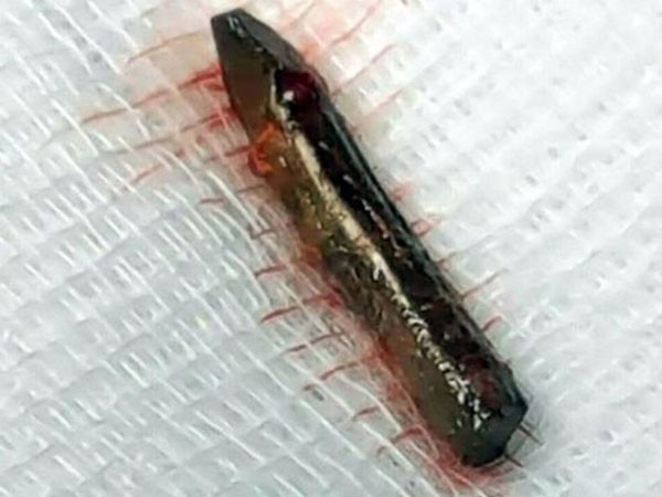 Sống sót dù đinh đâm vào tim ảnh 1 Sống sót dù đinh đâm vào tim ảnh 1