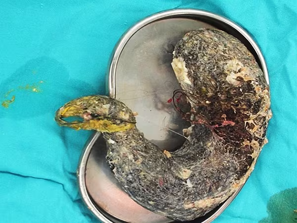 Phẫu thuật lấy búi tóc nặng 2kg ra khỏi dạ dày bé gái ảnh 2