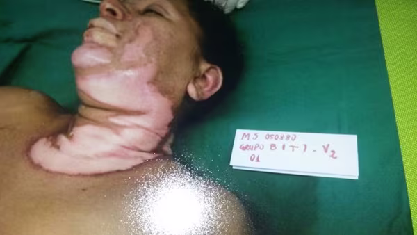 Người phụ nữ được chữa bỏng bằng da cá rô phi ảnh 2 Người phụ nữ được chữa bỏng bằng da cá rô phi ảnh 2