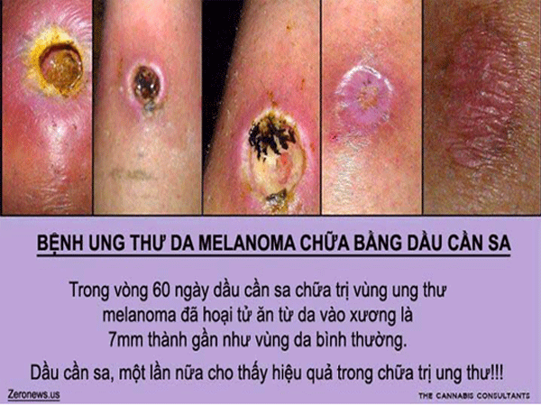 Thông tin cần sa chữa ung thư: Không khỏi bệnh mà còn gây nghiện ảnh 1 Thông tin cần sa chữa ung thư: Không khỏi bệnh mà còn gây nghiện ảnh 1