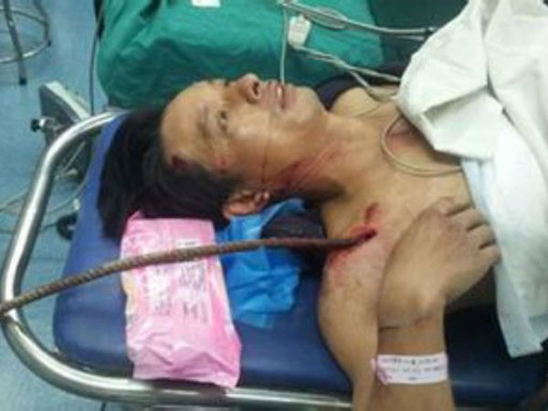 Sống sót dù thanh sắt xuyên qua ngực ảnh 1 Sống sót dù thanh sắt xuyên qua ngực ảnh 1