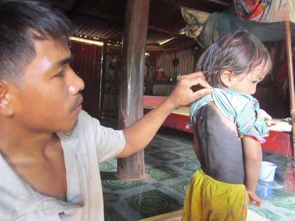 Xót thương cô bé 4 tuổi mọc lông đầy người ảnh 1 Xót thương cô bé 4 tuổi mọc lông đầy người ảnh 1