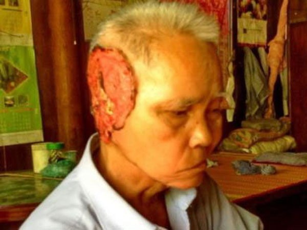"Vi khuẩn ăn mô người" lại tấn công ảnh 1 "Vi khuẩn ăn mô người" lại tấn công ảnh 1
