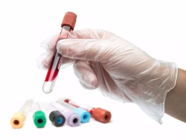 Thử máu phát hiện chấn thương não ảnh 1 Thử máu phát hiện chấn thương não ảnh 1