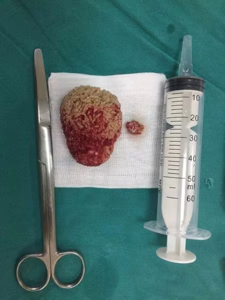 Bệnh nhân có sỏi thận to bằng quả trứng vịt ảnh 1 Bệnh nhân có sỏi thận to bằng quả trứng vịt ảnh 1