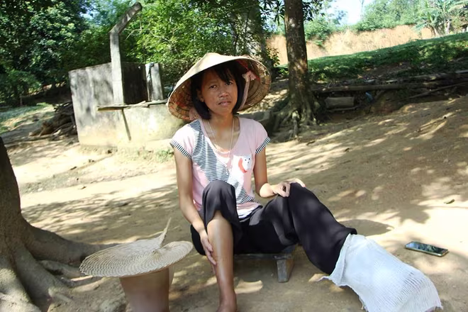 Nguyện vọng hiến xác khi lìa đời của cô gái bất hạnh bị u nhú lan rộng ảnh 1 Nguyện vọng hiến xác khi lìa đời của cô gái bất hạnh bị u nhú lan rộng ảnh 1