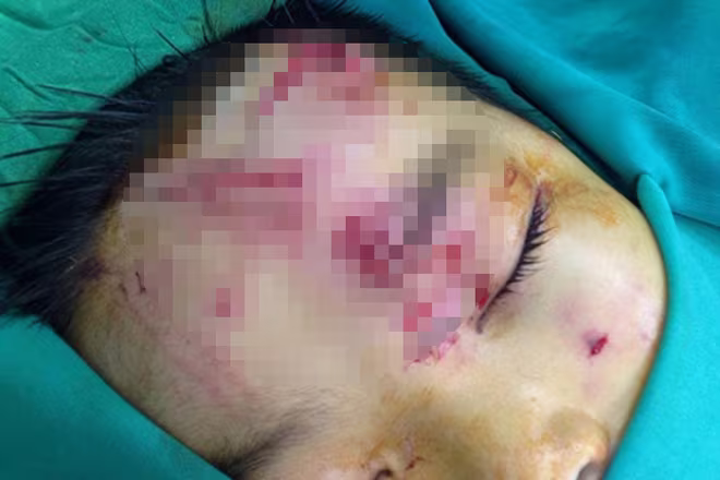 Bé trai 7 tuổi bị chó nhà tấn công cắn nát vùng mặt ảnh 1