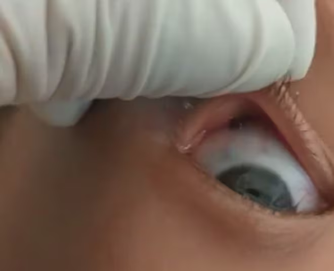 Gắp thành công con vắt sống trong mắt bé gái người H'Mông ảnh 1 Gắp thành công con vắt sống trong mắt bé gái người H'Mông ảnh 1