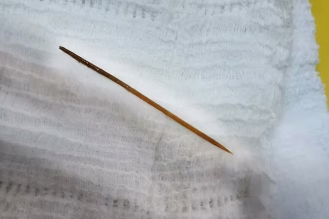 Ngủ quên, người đàn ông nuốt que tăm nhọn vào bụng ảnh 2