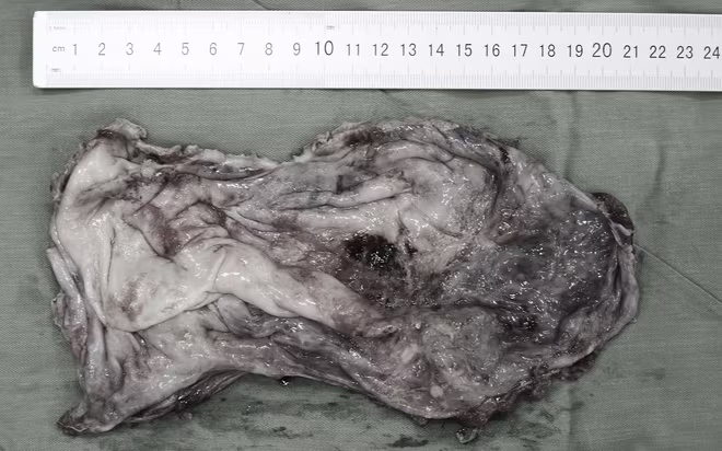 Phẫu thuật bóc thành công khối u nang buồng trứng to như quả bóng cho cô gái 21 tuổi ảnh 2 Phẫu thuật bóc thành công khối u nang buồng trứng to như quả bóng cho cô gái 21 tuổi ảnh 2