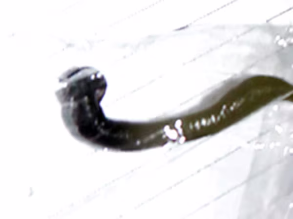 Đỉa sống trong thanh quản cháu bé 11 tuổi ảnh 1