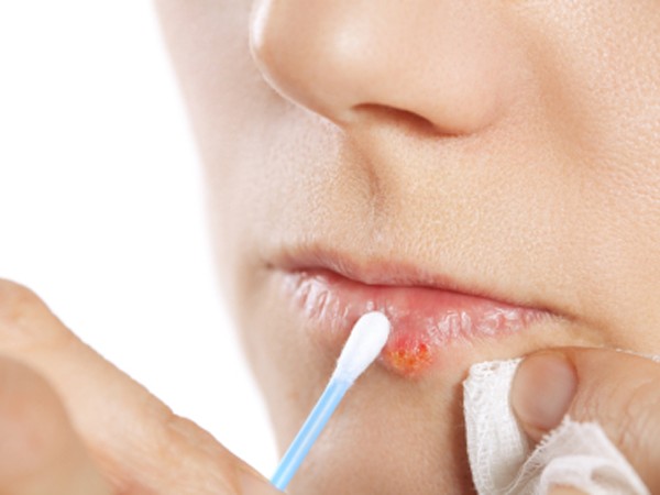 Trị những vết mụn lở không mong muốn ảnh 1 Trị những vết mụn lở không mong muốn ảnh 1