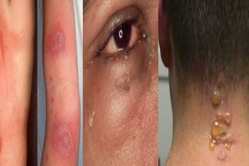 Vào "mùa" kiến ba khoang: Vết cắn giản đơn cũng có thể gây biến chứng ảnh 2 Vào "mùa" kiến ba khoang: Vết cắn giản đơn cũng có thể gây biến chứng ảnh 2