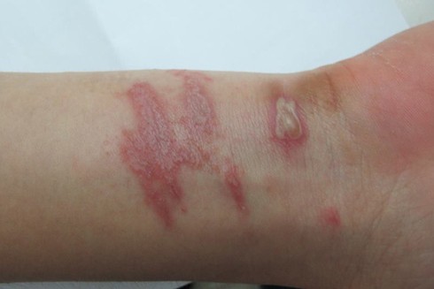 Vào "mùa" kiến ba khoang: Vết cắn giản đơn cũng có thể gây biến chứng ảnh 3 Vào "mùa" kiến ba khoang: Vết cắn giản đơn cũng có thể gây biến chứng ảnh 3