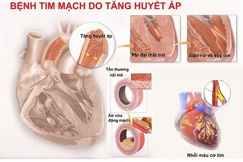 Cao huyết áp: Tưởng bình thường… nhưng "giết người" thầm lặng ảnh 1 Cao huyết áp: Tưởng bình thường… nhưng "giết người" thầm lặng ảnh 1