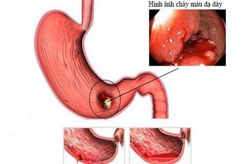 Xuất huyết dạ dày: Căn bệnh nguy hiểm…nhưng nhiều người coi thường ảnh 1 Xuất huyết dạ dày: Căn bệnh nguy hiểm…nhưng nhiều người coi thường ảnh 1