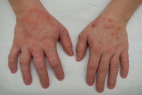 Viêm da cơ địa: Nỗi ám ảnh khôn nguôi ảnh 1 Viêm da cơ địa: Nỗi ám ảnh khôn nguôi ảnh 1