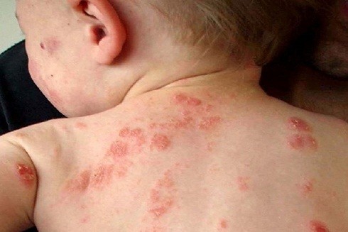 Viêm da cơ địa: Nỗi ám ảnh khôn nguôi ảnh 3 Viêm da cơ địa: Nỗi ám ảnh khôn nguôi ảnh 3