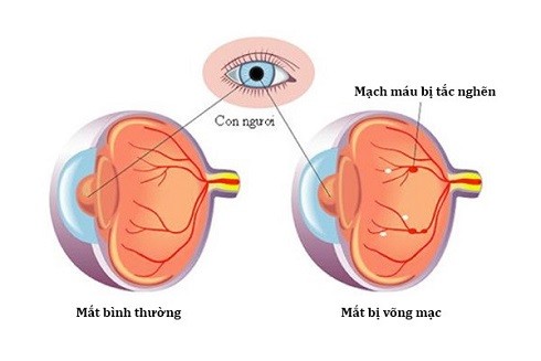 Cứ 6 giây 1 người chết: Bệnh tiểu đường nguy hiểm như thế nào? ảnh 3 Cứ 6 giây 1 người chết: Bệnh tiểu đường nguy hiểm như thế nào? ảnh 3