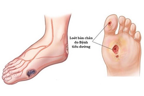 Cứ 6 giây 1 người chết: Bệnh tiểu đường nguy hiểm như thế nào? ảnh 4 Cứ 6 giây 1 người chết: Bệnh tiểu đường nguy hiểm như thế nào? ảnh 4