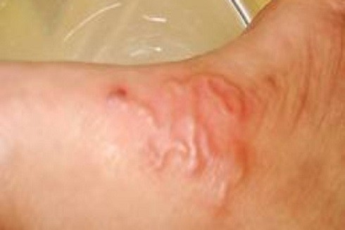 Nhiễm ấu trùng sán lợn: Nguy hiểm khôn lường ảnh 3 Nhiễm ấu trùng sán lợn: Nguy hiểm khôn lường ảnh 3