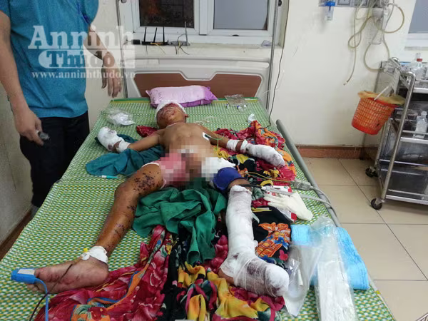 Đồ chơi lạ phát nổ, bé trai 9 tuổi bị đa chấn thương ảnh 1 Đồ chơi lạ phát nổ, bé trai 9 tuổi bị đa chấn thương ảnh 1
