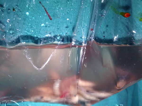 Cứu sống nam thanh niên có ổ giòi ký sinh trên đầu  ảnh 1