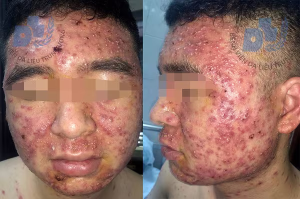 Dùng thuốc trị mụn mua trên facebook, nam thanh niên nhập viện với gương mặt gây kinh hãi ảnh 1 Dùng thuốc trị mụn mua trên facebook, nam thanh niên nhập viện với gương mặt gây kinh hãi ảnh 1