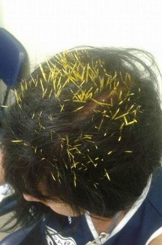 Nhập viện vì bị 200 gai nhím cắm vào đầu ảnh 1 Nhập viện vì bị 200 gai nhím cắm vào đầu ảnh 1