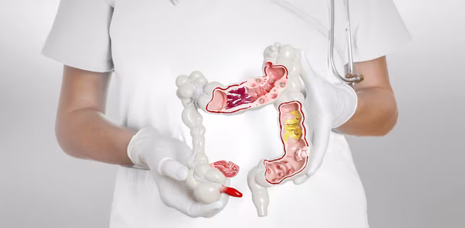 Các bệnh lý tiêu hóa không được điều trị đúng cách rất dễ dẫn đến ung thư Các bệnh lý tiêu hóa không được điều trị đúng cách rất dễ dẫn đến ung thư