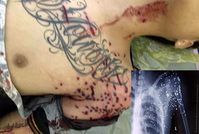 Nạn nhân trong vụ nổ súng với chi chít vết đạn trên cơ thể vẫn trong tình trạng nguy kịch