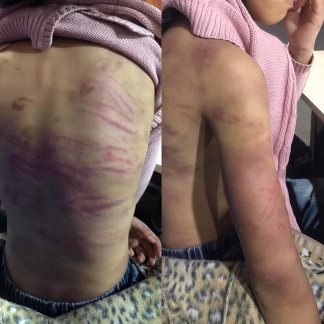 Hình ảnh bé B. được cho là bị mẹ đẻ và "người tình" bạo hành Hình ảnh bé B. được cho là bị mẹ đẻ và "người tình" bạo hành