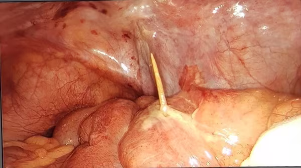 Hình ảnh nội soi ổ bụng của bệnh nhân phát hiện que tăm đâm thủng ruột non Hình ảnh nội soi ổ bụng của bệnh nhân phát hiện que tăm đâm thủng ruột non