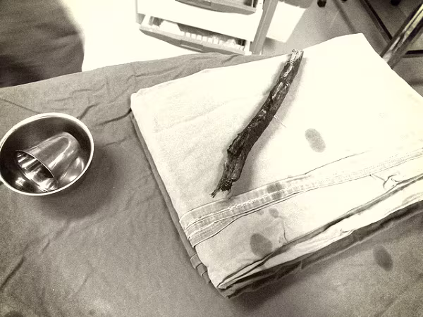 Dị vật là thanh gỗ xuyên thấu vùng mũi - mặt của bệnh nhân được bác sĩ lấy ra