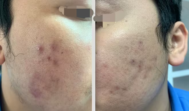 Sau hơn nửa năm điều trị tại BV Da liễu Trung ương, gương mặt nam bệnh nhân vẫn sần sùi Sau hơn nửa năm điều trị tại BV Da liễu Trung ương, gương mặt nam bệnh nhân vẫn sần sùi