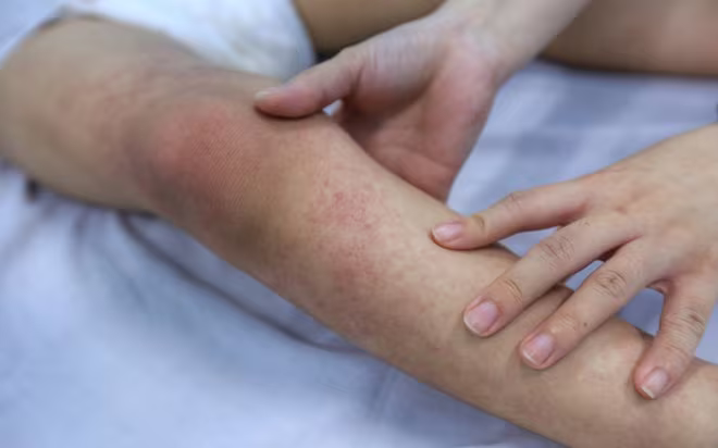 Số mắc SXH ở Hà Nội giảm nhẹ nhưng vẫn ở mức cao Số mắc SXH ở Hà Nội giảm nhẹ nhưng vẫn ở mức cao