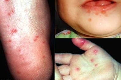 Sớm dập ổ dịch tay chân miệng ảnh 1 Sớm dập ổ dịch tay chân miệng ảnh 1