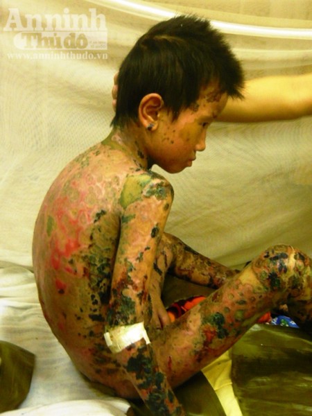 Dị ứng thuốc, bé trai 7 tuổi bị bong tróc da toàn thân ảnh 1 Dị ứng thuốc, bé trai 7 tuổi bị bong tróc da toàn thân ảnh 1