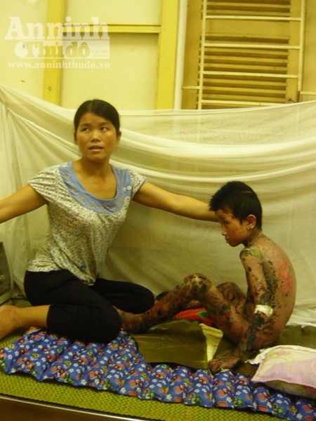 Dị ứng thuốc, bé trai 7 tuổi bị bong tróc da toàn thân ảnh 2 Dị ứng thuốc, bé trai 7 tuổi bị bong tróc da toàn thân ảnh 2