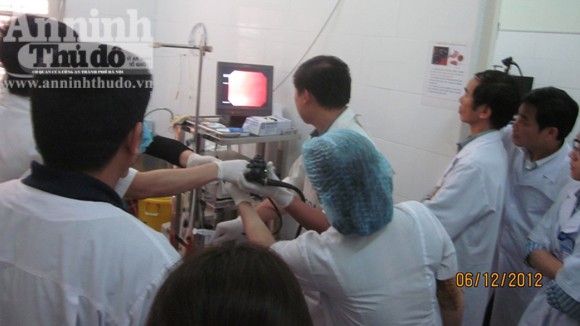 Cụ bà 77 tuổi bị dị vật "kết tinh" dài 6 cm mắc trong tá tràng ảnh 1 Cụ bà 77 tuổi bị dị vật "kết tinh" dài 6 cm mắc trong tá tràng ảnh 1