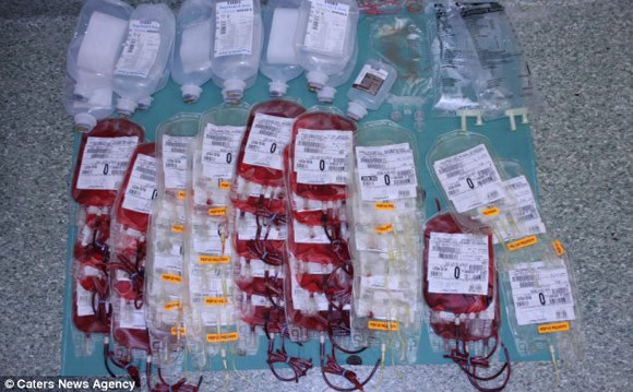 Cắt bỏ khối u nặng 36 kg trong dạ dày người phụ nữ ảnh 2 Cắt bỏ khối u nặng 36 kg trong dạ dày người phụ nữ ảnh 2