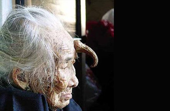 "Bí ẩn" những chiếc sừng mọc trên...đầu người ảnh 3 "Bí ẩn" những chiếc sừng mọc trên...đầu người ảnh 3