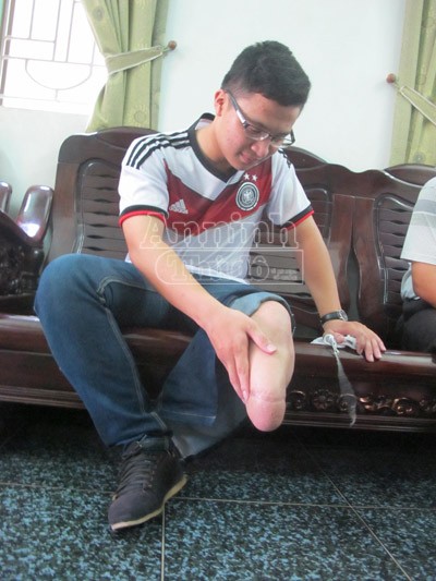 Nam sinh bị cưa mất chân trái và mơ ước được đến giảng đường ảnh 1 Nam sinh bị cưa mất chân trái và mơ ước được đến giảng đường ảnh 1