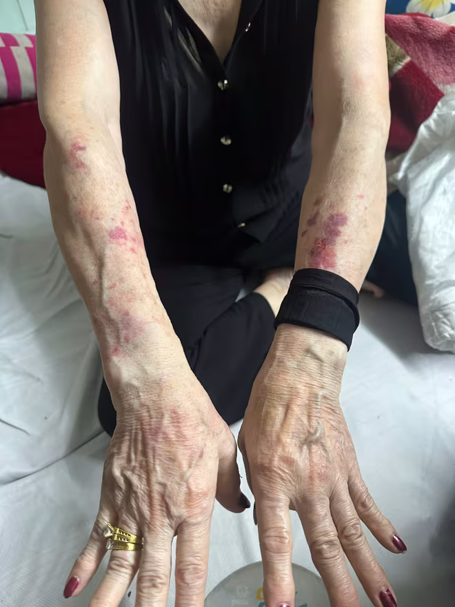 Những vết thương để lại trên tay người bị hại sau quá trình giằng co với hai tên cướp Những vết thương để lại trên tay người bị hại sau quá trình giằng co với hai tên cướp