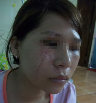 Nạn nhân sau 15 ngày điều trị Nạn nhân sau 15 ngày điều trị