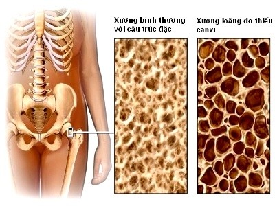7 cách phòng ngừa loãng xương ảnh 1 7 cách phòng ngừa loãng xương ảnh 1