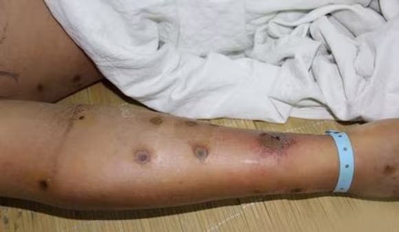 Kinh sợ loài ong khổng lồ, cực độc khiến 42 người vong mạng ảnh 3 Kinh sợ loài ong khổng lồ, cực độc khiến 42 người vong mạng ảnh 3